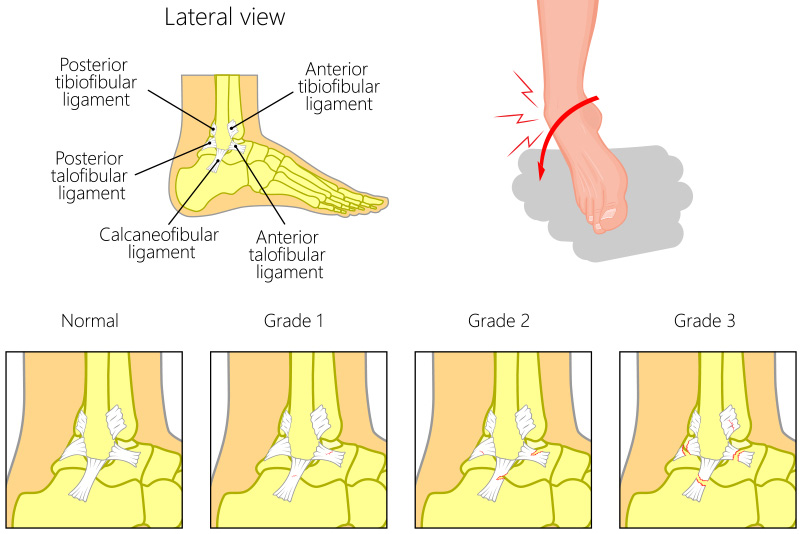 ankle sprain