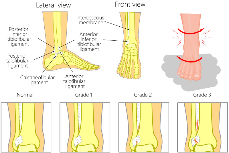 ankle sprain