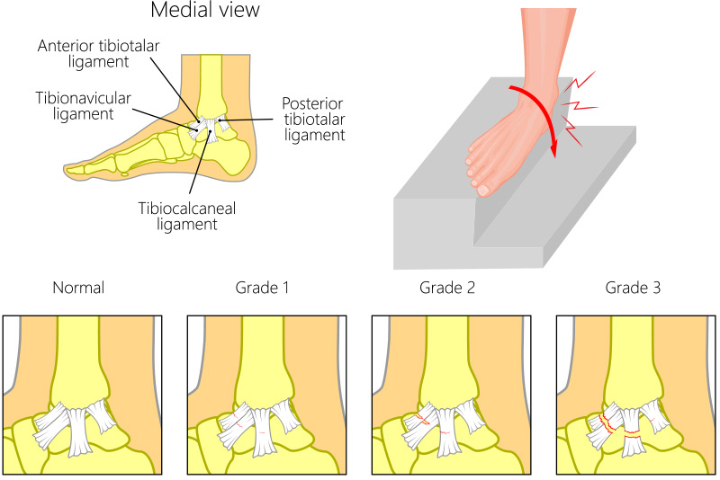 ankle sprain